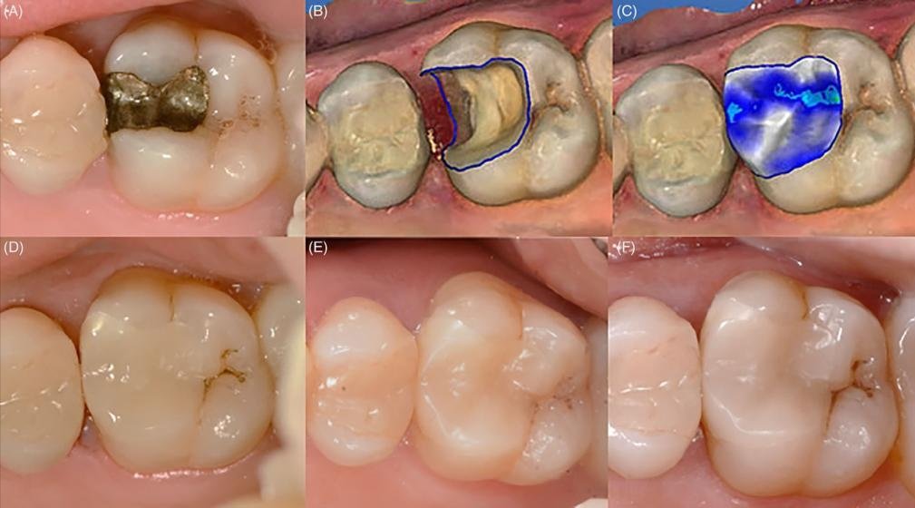 بين الماضي والحاضر الدكتور حبيب ظريفه يوضح عن آلية استخدام تقنية CAD/CAM Technology في طب الأسنان - صورة مميزة صورة مميزة: بين الماضي والحاضر الدكتور حبيب ظريفه يوضح عن آلية استخدام تقنية CAD/CAM Technology في طب الأسنان