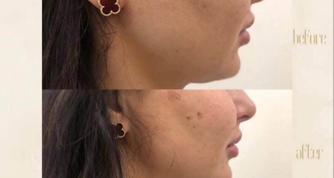 صورة مميزة: مركز Dermanda Clinic يقدم HIFU